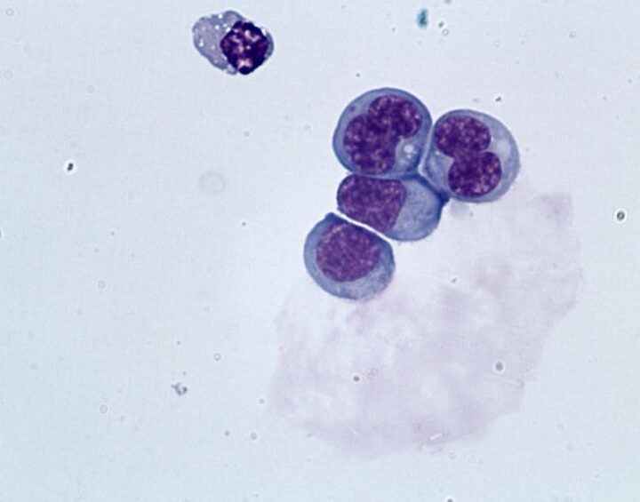 Relato de caso: linfoma de células T angioimunoblástico com comprometimento de Sistema Nervoso Central
