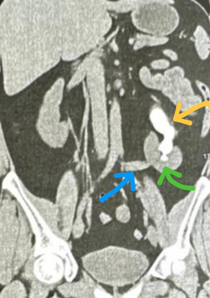Tratamento de resgate do cálculo renal gigante com pielolitotomia videolaparoscópica após nefrolitotripsia percutânea