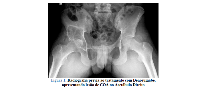 Cisto Ósseo Aneurismático Primário: Série de Casos tratados com Denosumabe em População Pediátrica